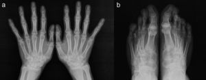 (a and b) Hand and feet X-rays show osteopenia, tubular epiphyseal widening and loss of joint space, without erosions.