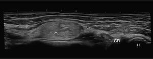 Longitudinal ultrasound view of the left elbow and forearm. CR, radial head; H, humerus; m, mass.