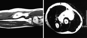T2 MRI of the forearm. (Left) Longitudinal aspect where the mass is observed above the radius. (Right) Cross section showing the mass causing a displacement of the theoretical area through which the median nerve passes (dotted circle). c, ulna; CR, radial head; H, humerus; m, mass; R, radio.