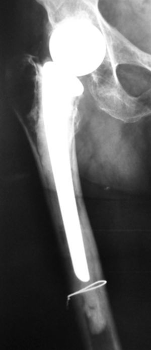 X-ray of hip prosthesis.