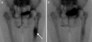 (a) Bone scan showing displacement of the prosthesis at the femoral shaft level (arrow). (b) Same patient after 6 months of treatment with strontium ranelate.