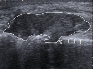 Longitudinal section of the right fifth metacarpal head. A mass of soft tissue is seen in contact with the cortical bone (narrow arrows) and cortical erosion (thick arrow) with a soft-tissue mass in the core of the metacarpal bone.