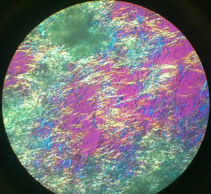 monosodium urate crystals viewed by polarized light microscopy.