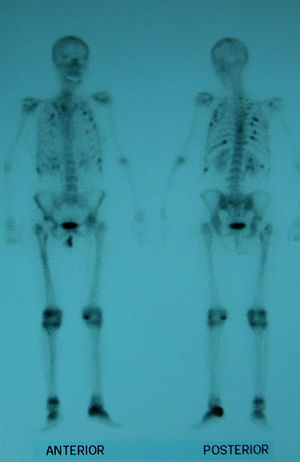Scintiscan Uptake in Multiple Ribs, Fractured Left Hip, Left Calcaneus and Peripheral Joints.