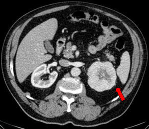 CT scan where a 79mm mass is seen in the upper pole of the left kidney, with a necrotic center and possible sources of perirenal fat invasion at the top corner.