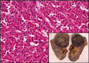 Macroscopic: reddish-brown well defined nodule 8×7cm with a fibrous core. Microscopic: solid proliferation of monomorphic cells with little nuclear atypia and abundant eosinophilic cytoplasm of oncocytic appearance.