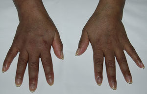 Hyperpigmentation on the back of the hands and lineal melanonychia.