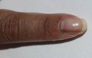 Detail of the hyperpigmented nail band (longitudinal melanonychia) extending to the cuticula and the adjacent periungueal area.
