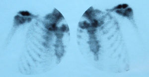 Tc99 scan which revealed both acromioclavicular joints increased uptake in a patient with septic polyarthritis.