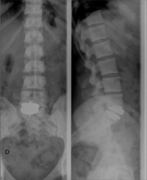 X-ray of the lumbar spine showing numerous small, well-defined, homogeneous, circular, increased radiodensity foci in the vertebral bodies.