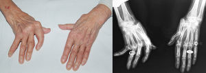 Jaccoud arthropathy on the hands, with ulnar deviation of the MCP, ‘gooseneck’ deformity and ‘Z’ thumb deviation with these deformities being more pronounced on the right hand (A). X-ray of the hands in which, in addition to the abovementioned deformities we find juxtaarticular osteopenia, chondrocalcinosis of the right carpus and absence of erosions or degenerative signs (B).