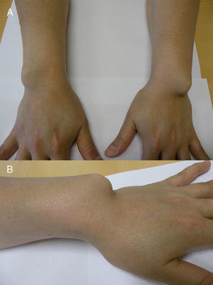 Panel A shows the ulnar aspect of both wrists, with a prominence that corresponds to the ulnar head, better seen on the left wrist. Panel B shows a lateral view of the left wrist.