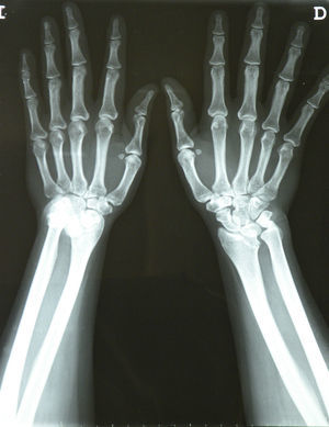 Posteroanterior X-ray of both wrists.