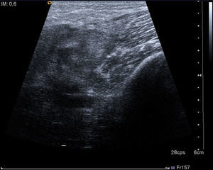 A soft tissue ultrasound revealed a dysfunctional muscle area in relation with the vastus medialis of quadriceps and the adductors muscles.