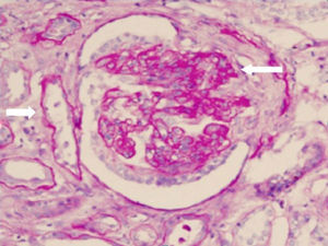 Renal biopsy evidence of glomerulonephritis with segmental necrotizing extracapillary proliferation (long arrow) with marked interstitial fibrosis and tubular atrophy (short arrow).