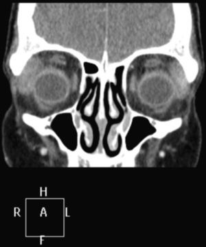 Cerebral magnetic resonance: increase in the size of the superior and lateral right orbit, compatible with an infiltrating process.