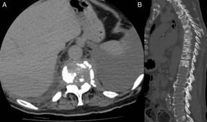 axial and sagittal CT reconstruction showing the dorsal vertebral disorganization with lysis and sclerosis primarily on the D3–D12 vertebrae, with intervertebral space disappearance of D7–D8 by spondylodiscitis and left pleural effusion.