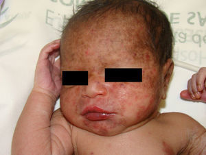 Clinical case 2. Brownish erythematous scaly lesions on the face, with periocular mask distribution.