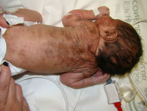 Clinical case 2. Brownish erythematous lesions on the back.