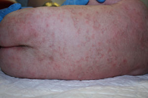 Clinical case 4. Annular, erythematous skin lesions with a clear center.