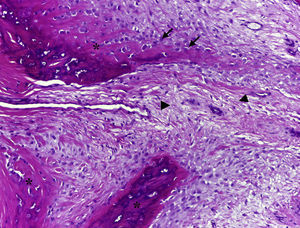 Photomicrograph of the lesion in which the production of immature osteoid (asterisk) is observed, with abundant osteoblasts (arrows) originating from a fibrous stroma (arrowheads) (hematoxylin–eosin, 10×).