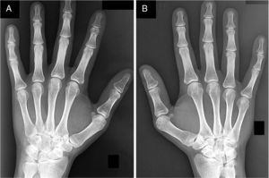 Anteroposterior X-rays of the left (A) and right carpus (B) showing bilateral Madelung