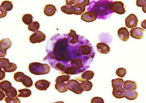 Bone marrow aspirate showing histiocyte with hemophagocytic activity (Wright-Giemsa stain).