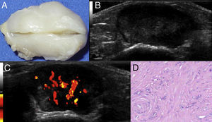 (A) Specimen obtained by surgical resection. (B) Grayscale ultrasound of the longitudinal axis of the lesion, showing defined edges, with alternating anechoic and isoechoic areas. (C) Positivity of the power Doppler signal (vascularity). (D) Histological section (hematoxylin–eosin) showing disorganized bundles of spindle cells (smooth muscle) and vascular thickening.