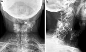 Anteroposterior and lateral cervical spine X-ray.