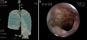 A lung computed tomography: (a) generalized frosted glass, cavitated nodules and cavitary consolidation, (b) cavitated pneumonia in the upper segment of the right lower lobe and non cavitated nodules in the left lower lobe.