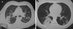 (a) Tracheal stenosis. (b) Image by bronchoscopy showing ulcerated tracheitis, necrotizing granulomatous vasculitis on histology.
