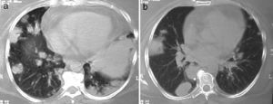 (a and b) Nodules and masses in the right lower lobe and consolidation on the periphery of the left lower lobe; histopathological analysis showed necrotizing granulomatous vasculitis and organizing pneumonia.