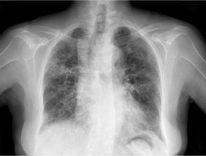 Postero-anterior chest X-ray where a diffuse and asymmetric bilateral reticular infiltrate can be seen, with peripheral involvement, predominantly in the right upper lobe.
