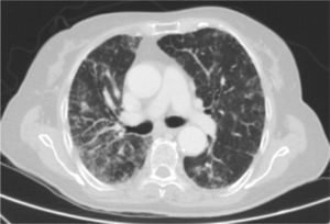 Thoracic HRCT where a bilateral interstitial infiltrate is seen along with patched areas of ground glass appearance.
