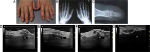 DIP osteoarthritis: image of hand (A), X (B) zoom of the joint (C) and corresponding ultrasound study from dorsal (D), medial (E), lateral (F) and palmar perspectives (G).