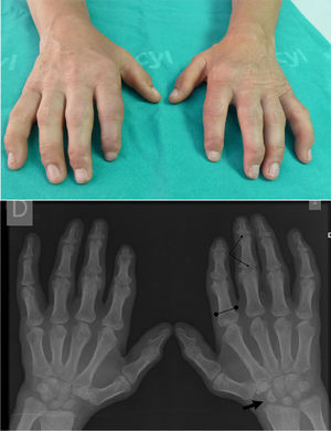 Claw Hand: impossible flexion and maximum extension, without objetive skin thickening or joint involvement. Hand X ray: small and irregular carpus bones (arrow) and wide proximal phalanges (bounded line). The attitude of the claw fingers produces an image of pseudoimpingement in the PIP and DIP joints (thin arrows).