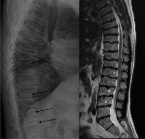 Dorsolumbar X-ray and MRI-T2: irregularity of the vertebral end plates (arrows). Intraspongy lumbar hernias are displayed on MR (*).