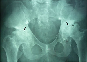 X-ray of the pelvis and hip dysplasia with impingement of the coxofemoral spaces, flattened acetabulum (arrows), femoral head deformity (^ ^) and secondary osteophytes (*). Sclerosis of the symphysis pubis (thin arrow).