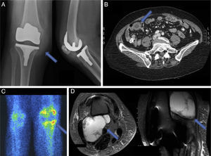 (A) X-ray of the right knee: increased soft tissue is observed. (B) CT: an increase in thickness can be seen in the wall of the ileum. (C) Technetium and gallium bone scan: increased uptake is seen in the right knee. (D) MRI: a posterior cystic mass is seen on the femur.