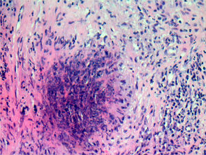 Detail of necrotizing granulomatous epithelioid cells surrounded organized as a palisade.