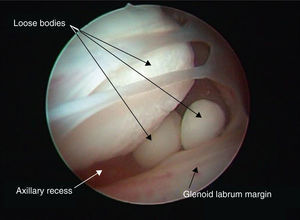 Arthroscopic image identifying intra-articular synovial chondromatosis-related loose bodies.