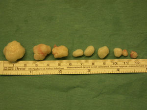Removal of 9 loose bodies. Note the comparative size.