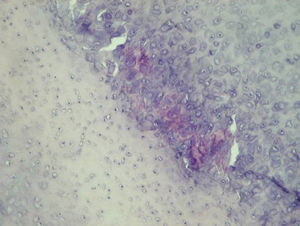 Histological image. Chondroid metaplasia associated with weakly birefringent crystals and giant cells.