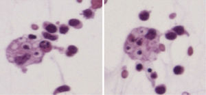 Ascites. Red cell within macrophages is observed.