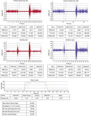 Patient with back pain. In surface electromyography a phenomenon of flexion/relaxation is recorded, which is indicative of the absence of LBP (discrepancy).