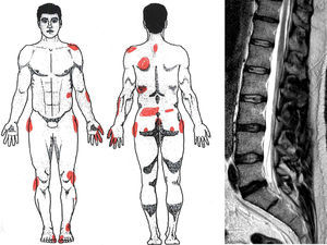 Discrepancy between MRI findings (L5-S1 disk disease) and body drawing in acute low back pain refractory to all treatment.