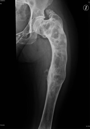 Anteroposterior X-ray of the left femur with a «shepherd
