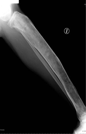 Lateral X-ray of the left tibia, which is curved and has a thin cortex.