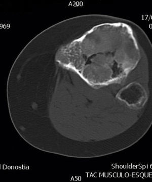 Computerized tomography of the tibia with axial images of the proximal end.