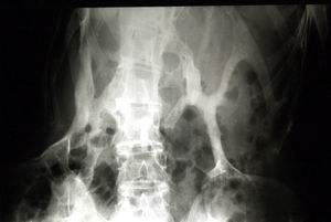 Thick bands of heterotopic bone of lamellar mature appearance (pattern of endochondral ossification) forming rigid bridges between various structures and eventually forming a true “second skeleton”.
